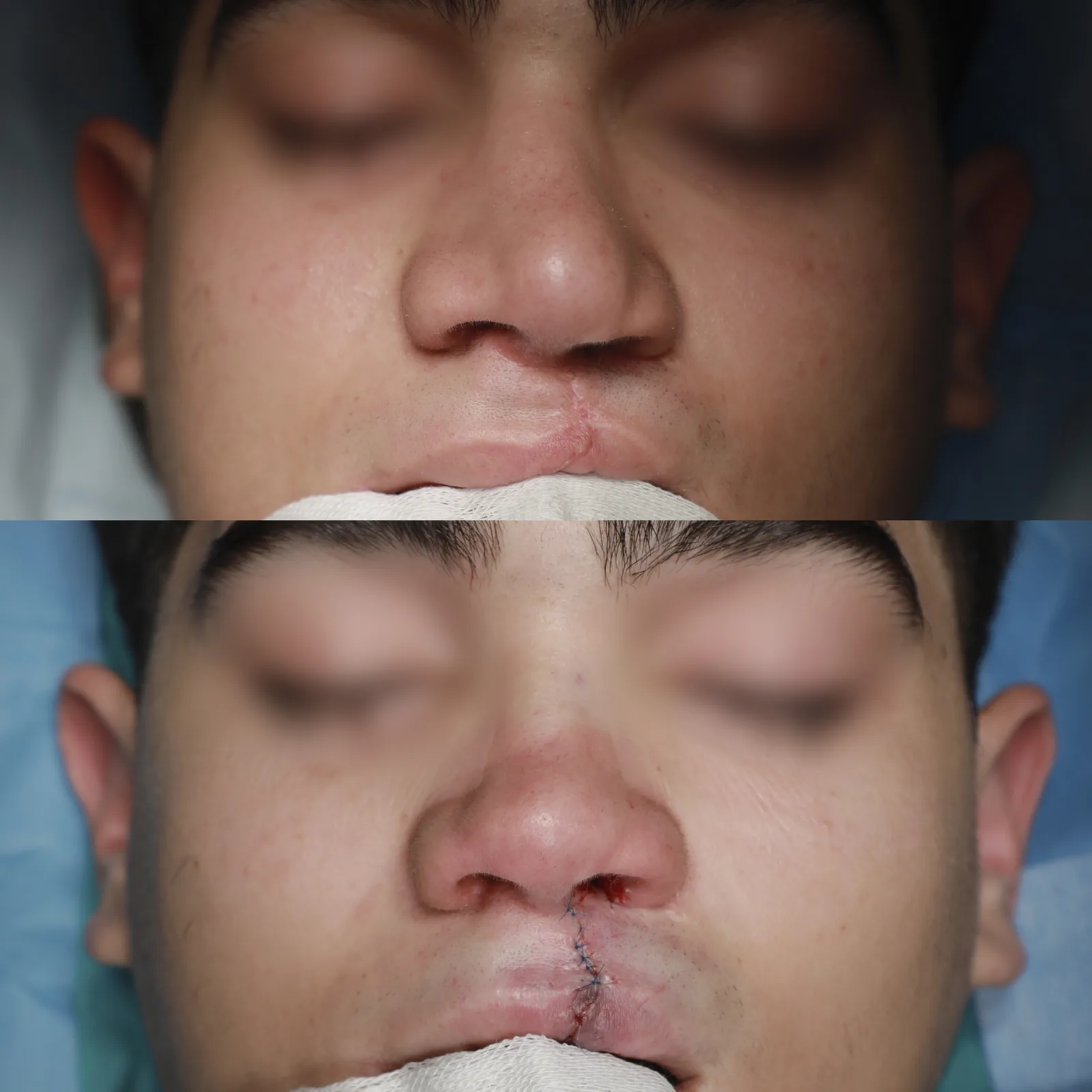 Frontal view before and immediately after cleft lip repair and cleft rhinoplasty by Teoman Dogan, MD PhD in Istanbul, case 1