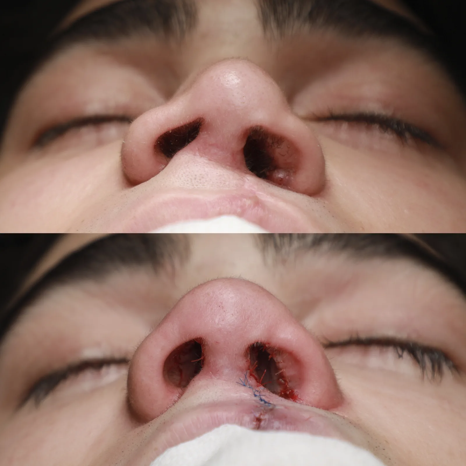 Basal view before and immediately after cleft lip repair and cleft rhinoplasty by Teoman Dogan, MD PhD in Istanbul, case 1