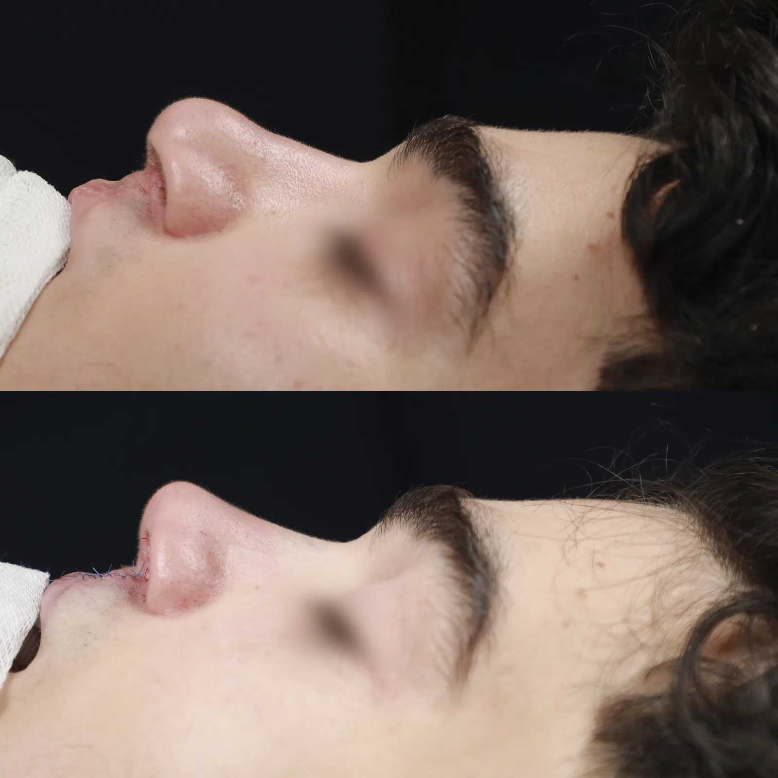 Left profile before and immediately after cleft lip repair and cleft rhinoplasty by Teoman Dogan, MD PhD in Istanbul, case 1