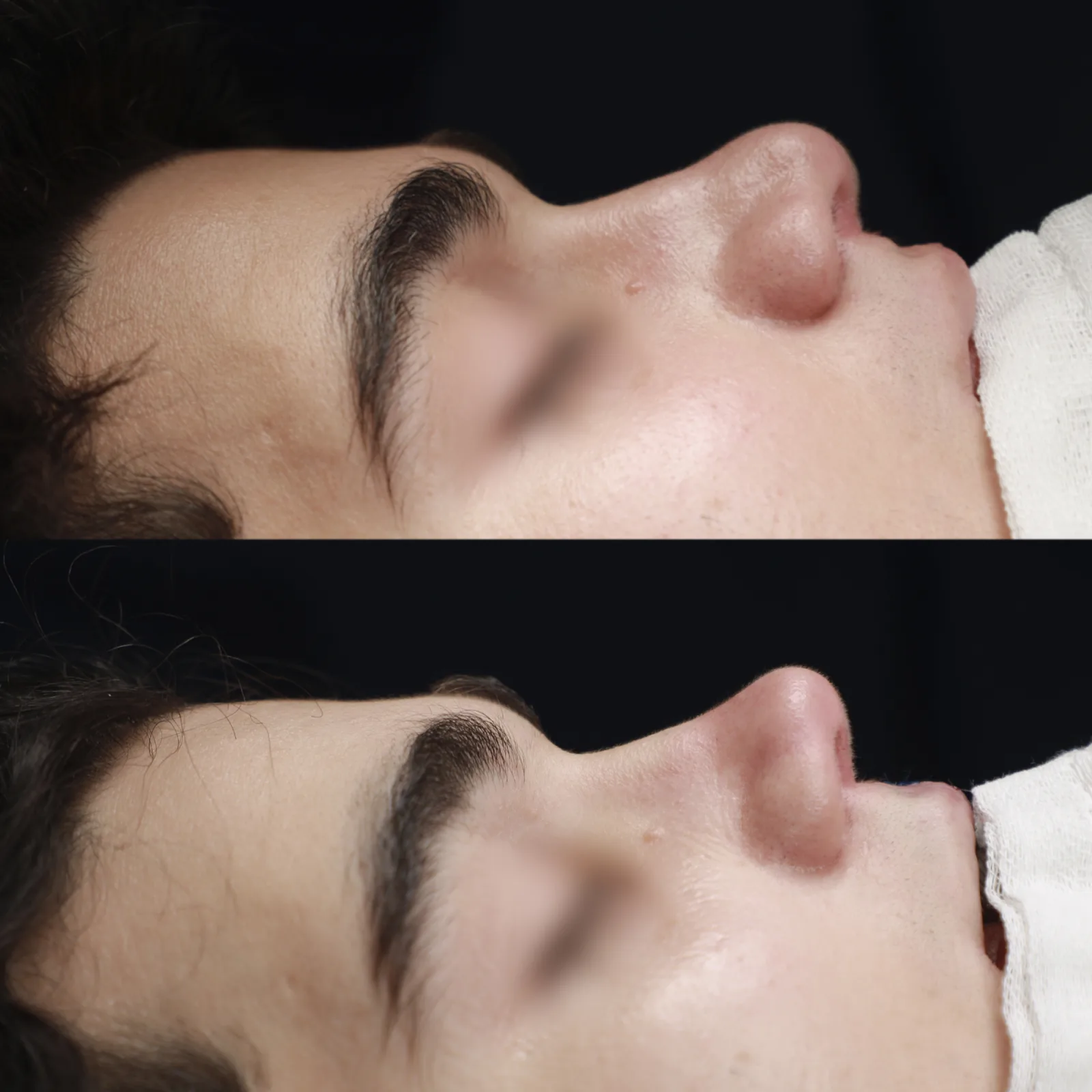 Right profile before and immediately after cleft lip repair and cleft rhinoplasty by Teoman Dogan, MD PhD in Istanbul, case 1