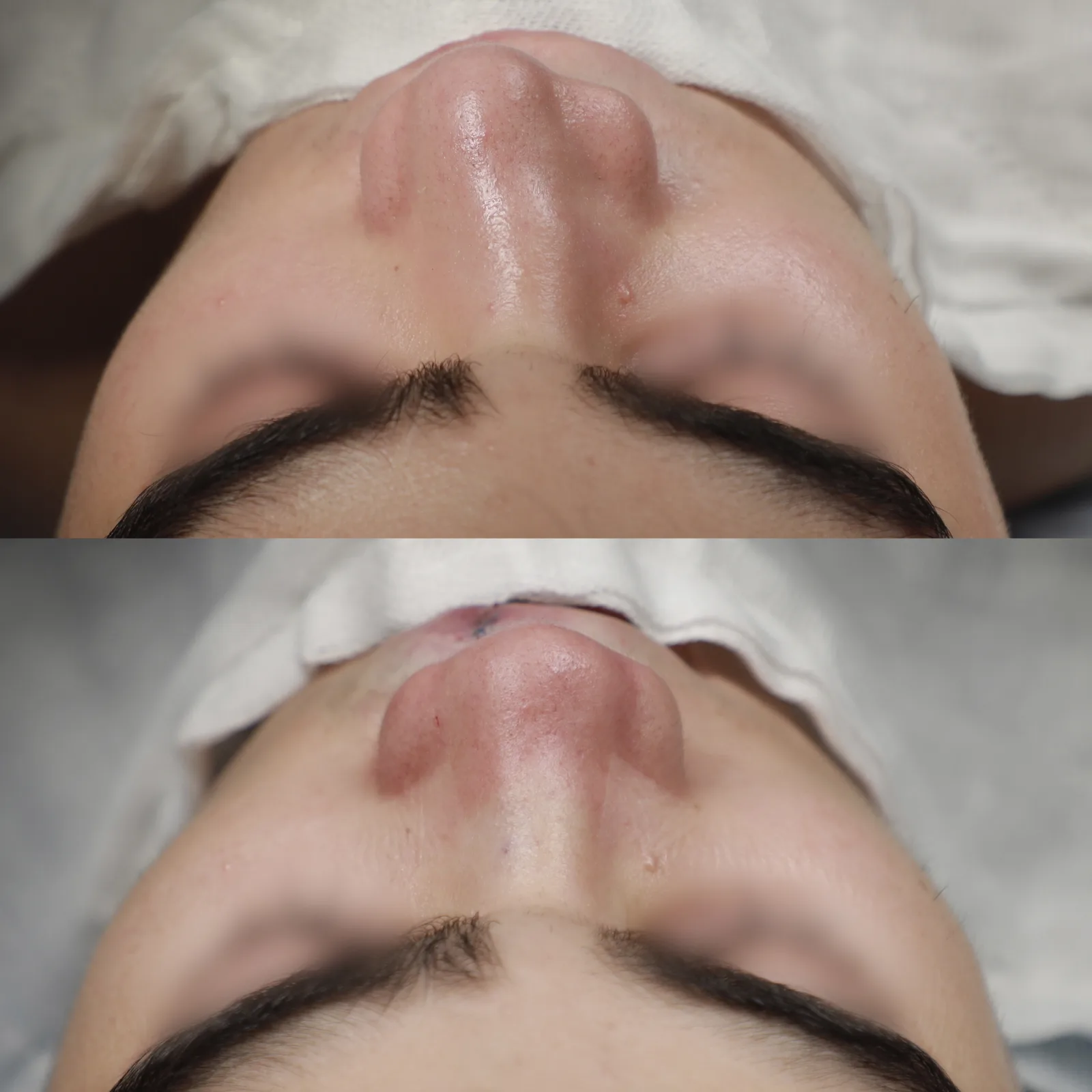 Top-down view before and immediately after cleft lip repair and cleft rhinoplasty by Teoman Dogan, MD PhD in Istanbul, case 1