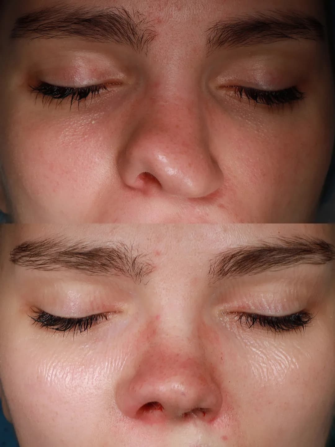 Frontal view before and immediately after cleft lip repair and cleft rhinoplasty by Teoman Dogan, MD PhD in Istanbul, case 2
