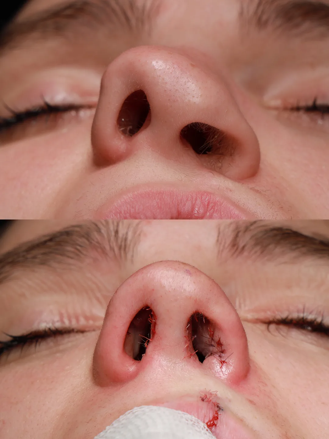 Basal view before and immediately after cleft lip repair and cleft rhinoplasty by Teoman Dogan, MD PhD in Istanbul, case 2
