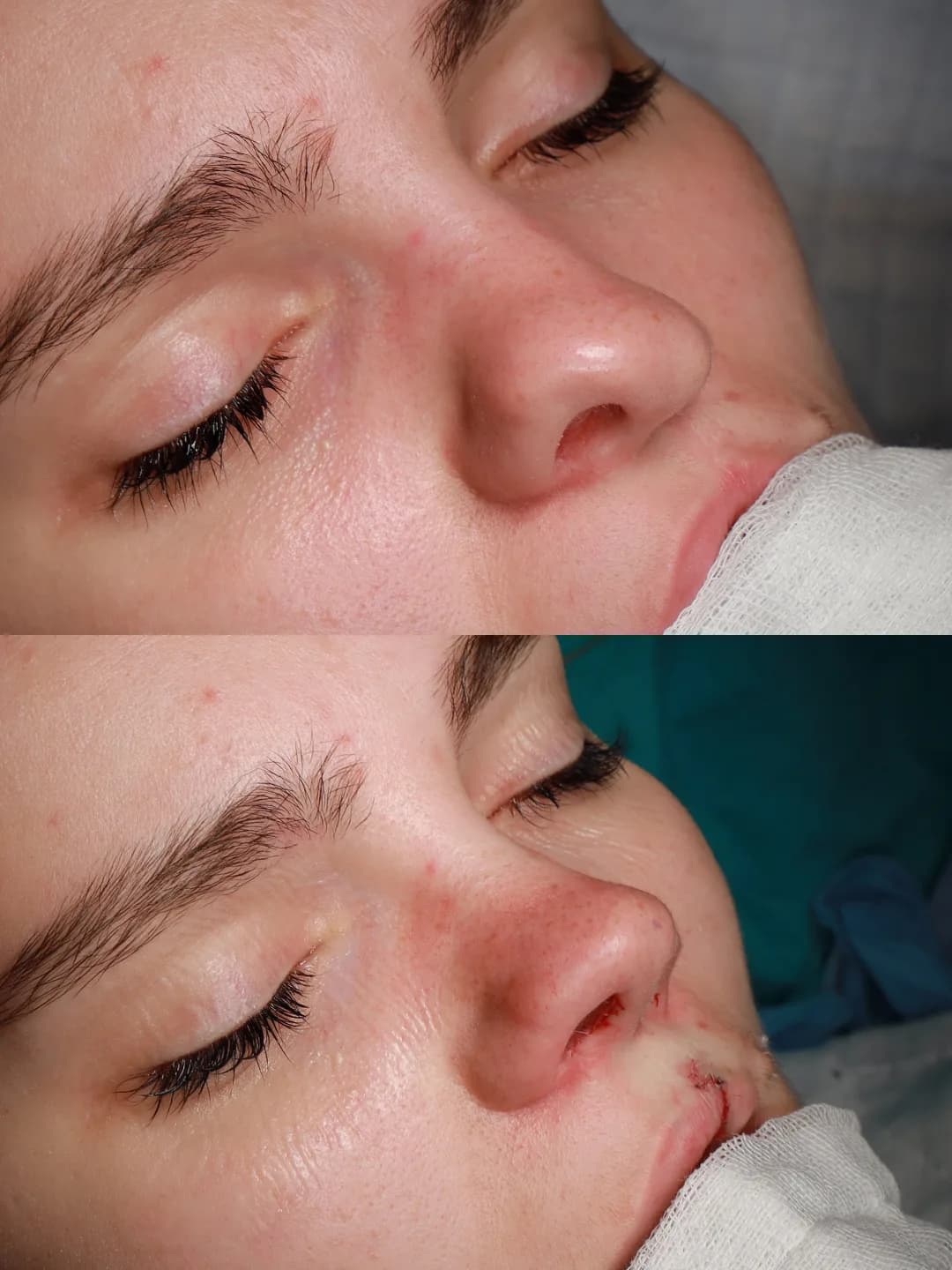 Oblique view before and immediately after cleft lip repair and cleft rhinoplasty by Teoman Dogan, MD PhD in Istanbul, case 2