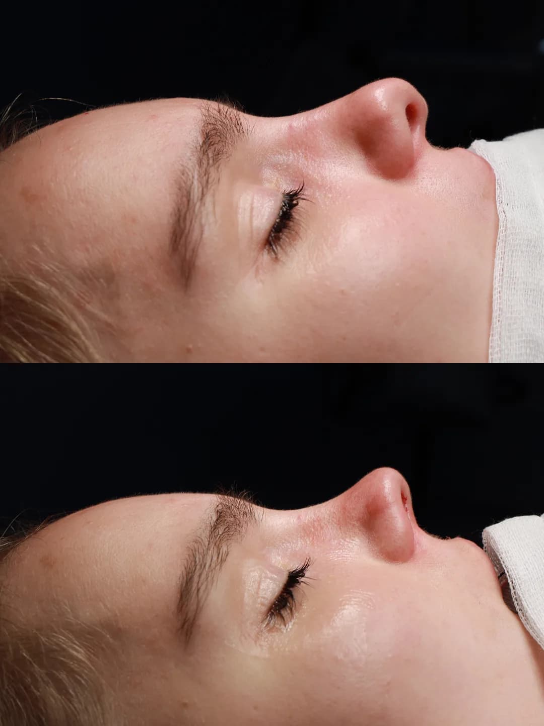 Profile before and immediately after cleft lip repair and cleft rhinoplasty by Teoman Dogan, MD PhD in Istanbul, case 2