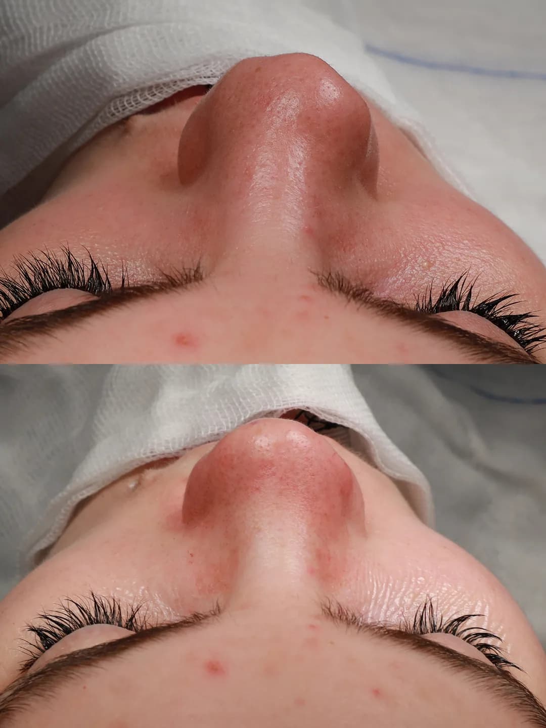 Top-down view before and immediately after cleft lip repair and cleft rhinoplasty by Teoman Dogan, MD PhD in Istanbul, case 2