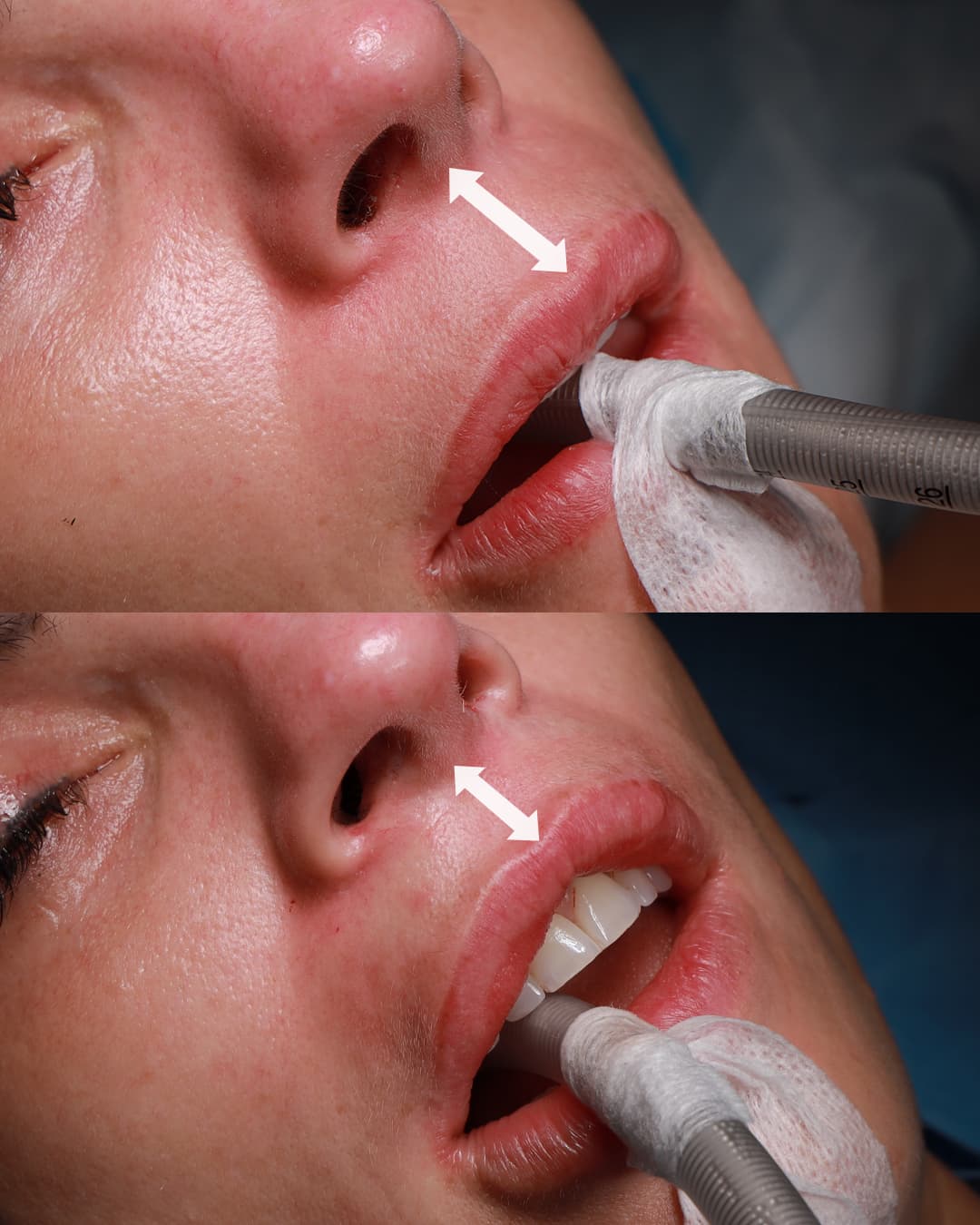 Scarless Lip Lift Patient 2